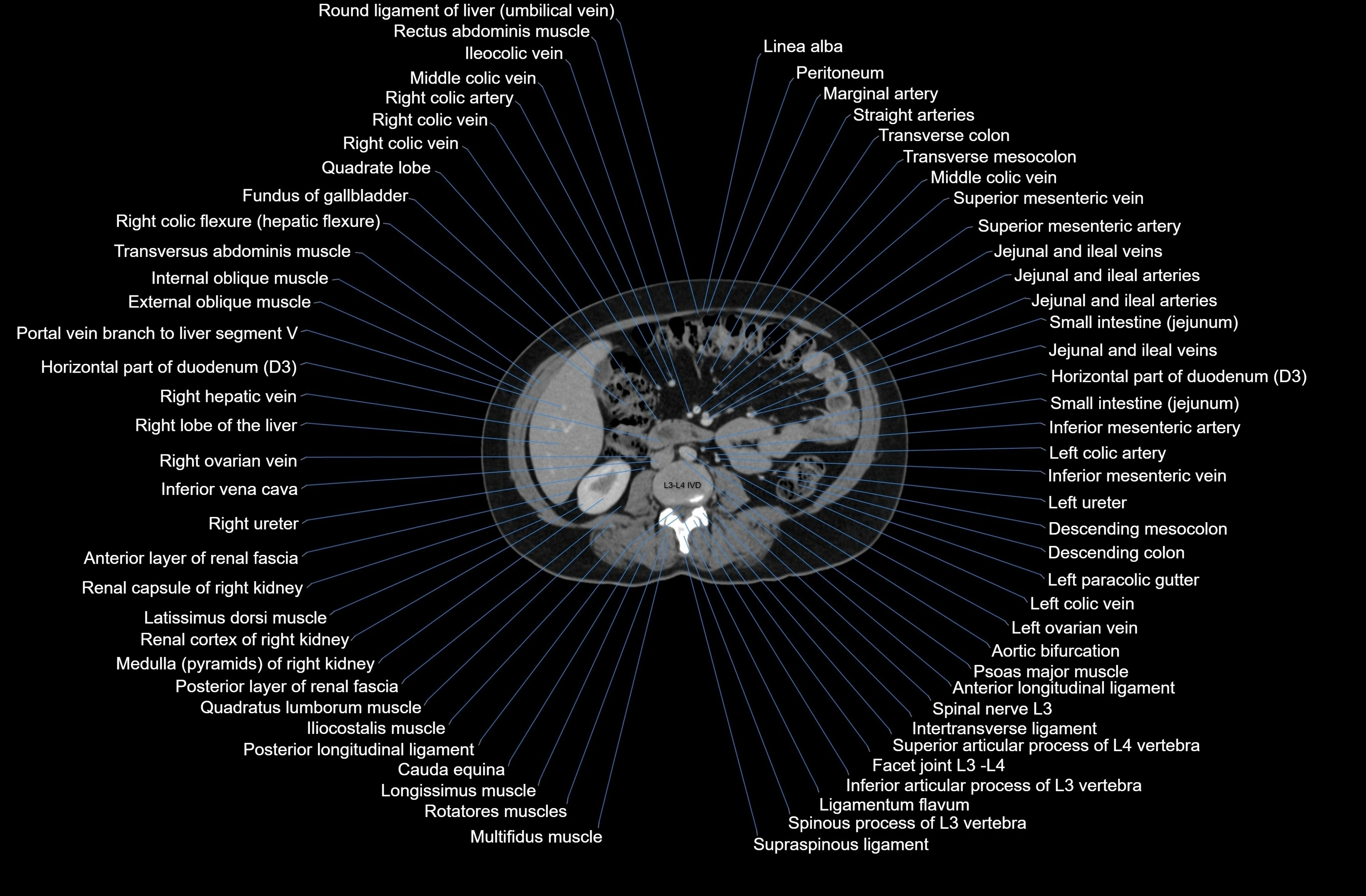 CT Abdomen axial cross sectional anatomy labelled radiology image-00047.webp